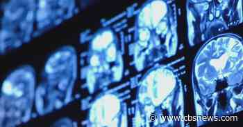 Experimental treatment could offer new hope for people with ALS