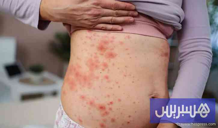 داء الحصبة يتفشى بالولايات المتحدة