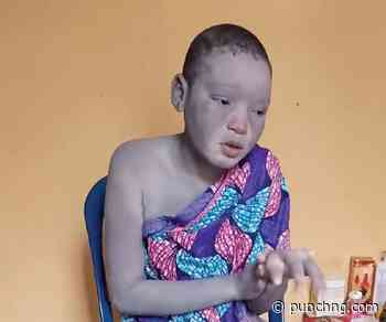 Passengers fled buses because of my skin condition — Anambra content creator