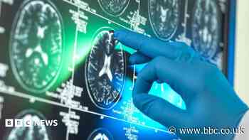 NHS trust joins Alzheimer's prevention drug trial