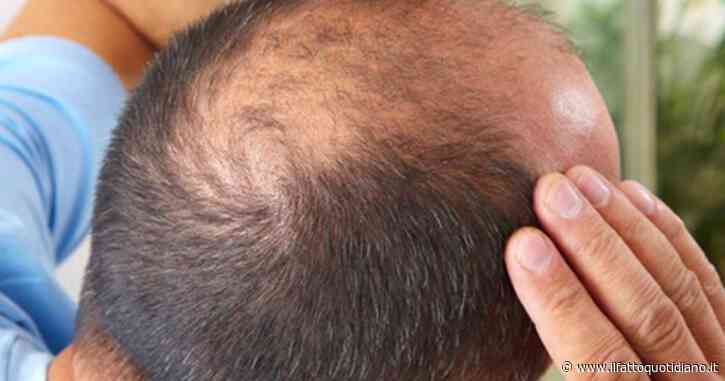“Prima era solo un sospetto, ora c’è la conferma. Ozempic, Wegovy e i farmaci dimagranti aumentano la perdita dei capelli, soprattutto negli uomini già predisposti all’alopecia”: il nuovo studio