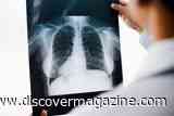 People With Lung Cancer Had Higher Levels of Microplastics in Their Lungs