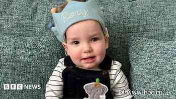 World-first surgery for baby's rare skull condition