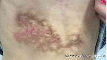 Boy develops terrifying 'toasted skin syndrome' from resting laptop on his body - doctors issue warning