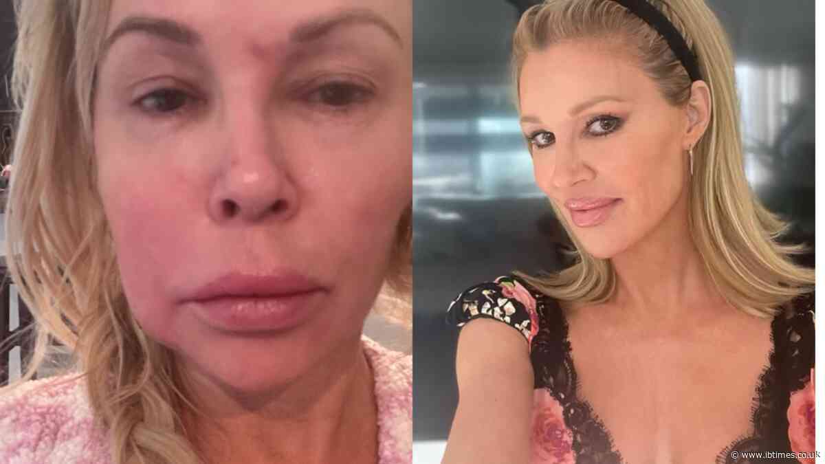 Real Housewives of Beverly Hills Star Brandi Glanville Shares Details About 'Parasite' That Causes 'Fungal Ball' On Her Face