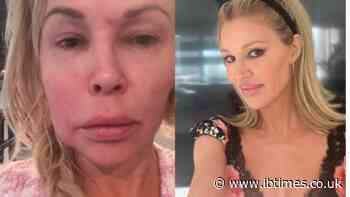 Real Housewives of Beverly Hills Star Brandi Glanville Shares Details About 'Parasite' That Causes 'Fungal Ball' On Her Face