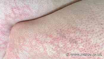 Toasted skin syndrome: All you need to know as cases of horror burns soar in kids