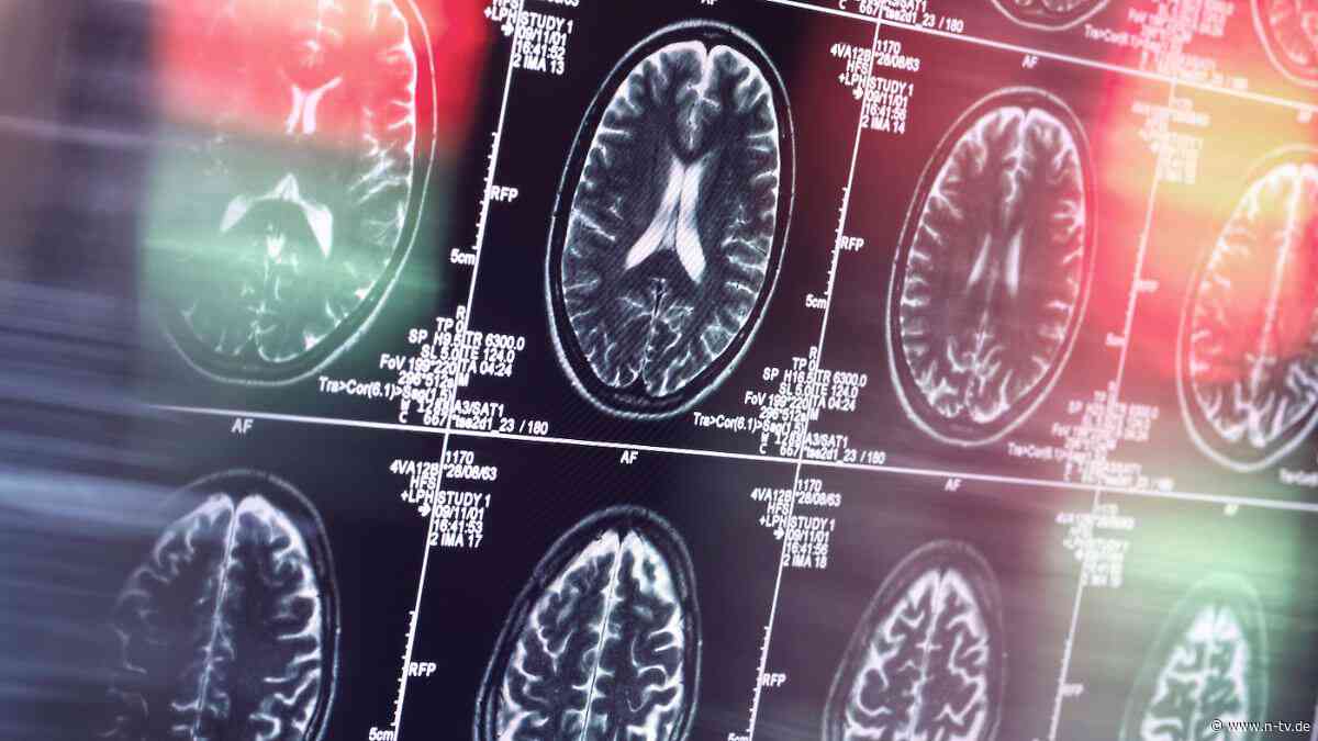 Eingriff am Hals: Alzheimer operieren? Was hinter der umstrittenen Methode steckt