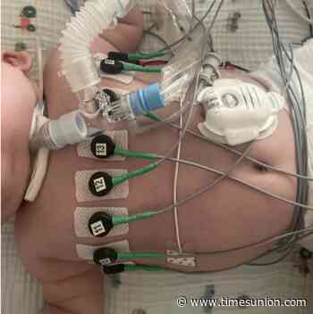 UAlbany engineer is heading to the FDA for approval of noninvasive lung monitor for premature infants