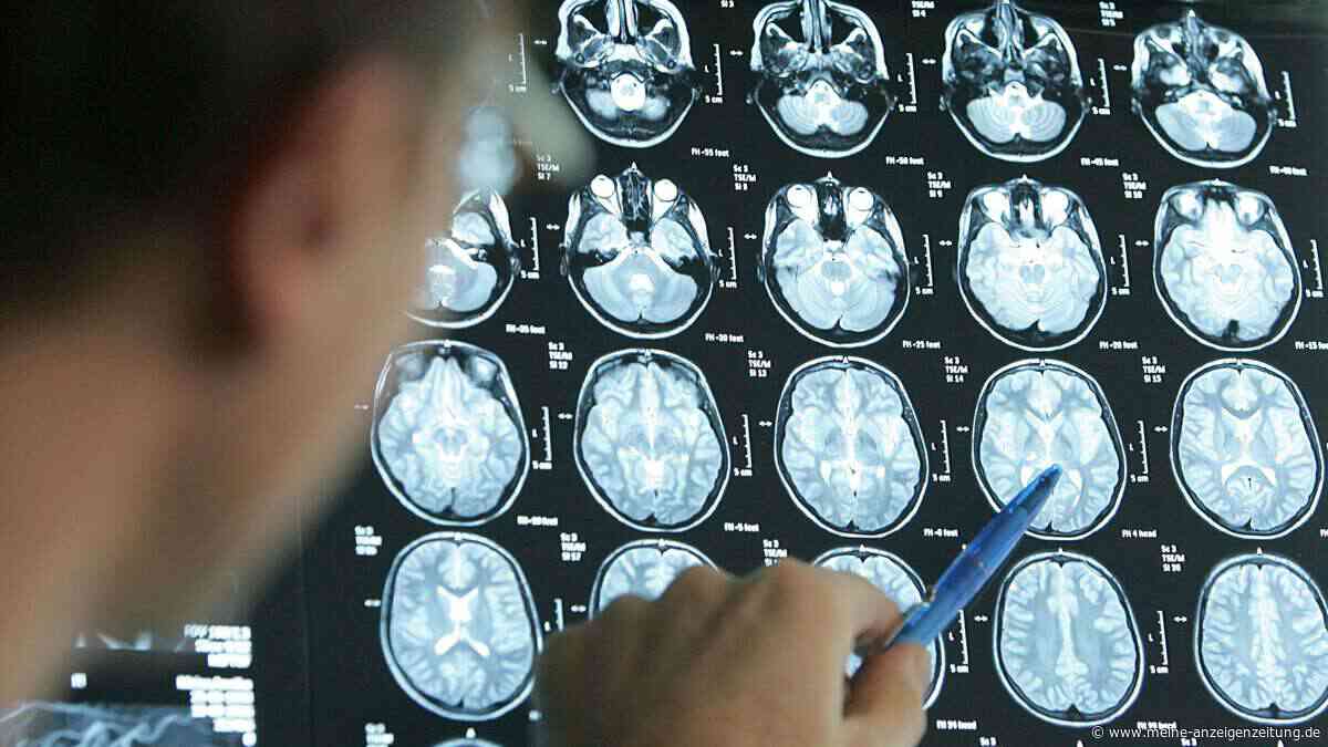 Mehr Schlaganfälle bei jungen Menschen: Studie nennt kritische Stundengrenze im Job