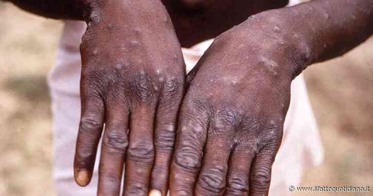 Vaiolo delle scimmie, l’Oms: “È ancora un’emergenza”. Il virus Mpox circola anche in Italia, preoccupa la trasmissione per via sessuale
