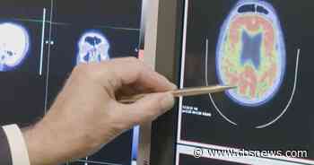 Six million Americans at risk of suffering an aneurysm