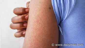The little-known condition that causes unsightly 'permanent goosebumps' - and up to 40 per cent of adults have it. This is exactly how to banish 'chicken skin' for good... and what NOT to do: DR SABIKA KARIM