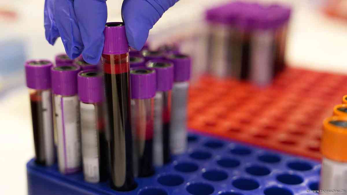 Neuer Bluttest weckt Hoffnung auf Früherkennung bei Bauchspeicheldrüsenkrebs