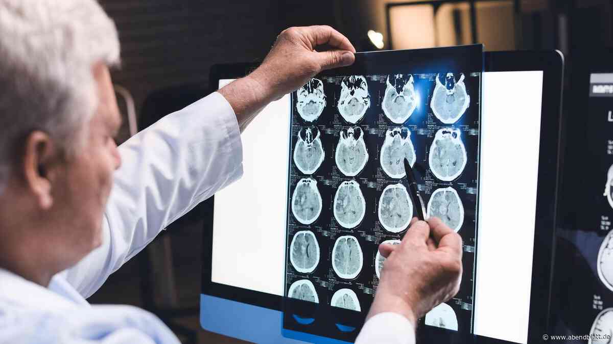 Aneurysma im Gehirn: Warum der Befund meist nur zufällig erfolgt