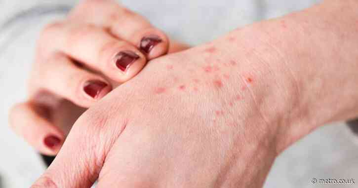 A parasitic bug that eats human skin cells is thriving in the UK right now