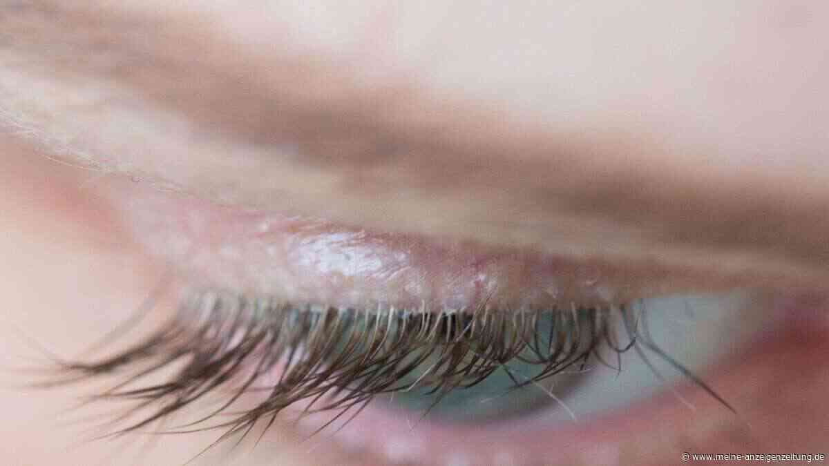 Milben am Auge: Wie man den Befall erkennt und bekämpft