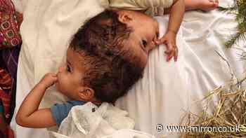 Conjoined twins given new chance at life after extraordinary 24-hour separation surgery