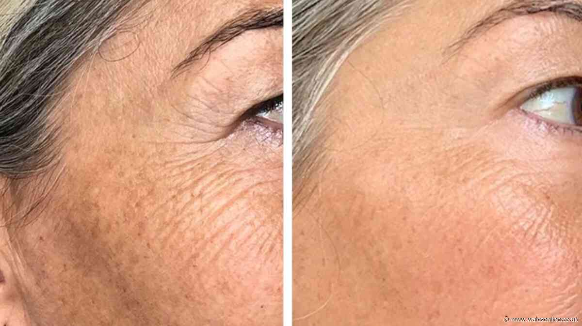 Woman says £240 off face mask makes big 'difference to wrinkles in 2 weeks of use'