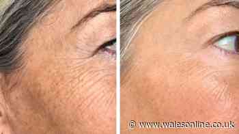 Woman says £240 off face mask makes big 'difference to wrinkles in 2 weeks of use'