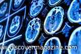 The Brain May Be Two Organs, a Discovery That Could Advance ALS Research
