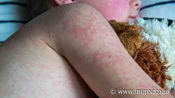 Measles cases soar after ten-year fall in vaccines - see numbers in your area
