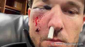 Baseball star left with brutal injuries after being struck in the FACE by foul ball
