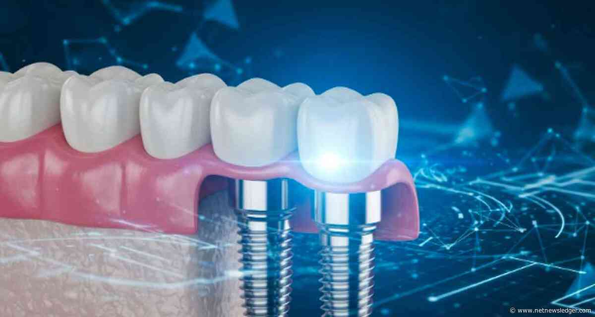 Why Dental Implants Are a Long-Term Solution for Tooth Loss
