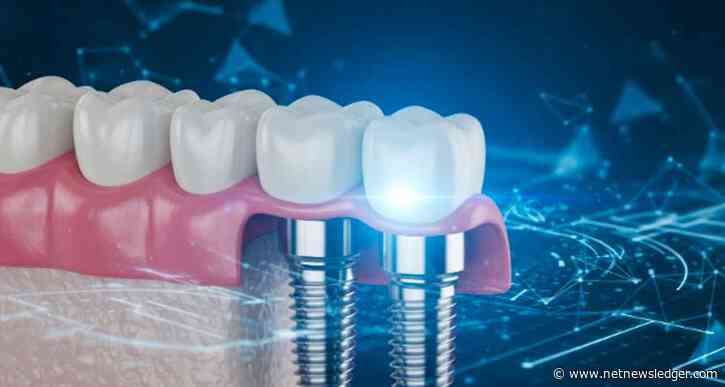 Why Dental Implants Are a Long-Term Solution for Tooth Loss