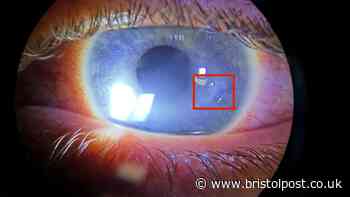 'I thought I was stressed at work then doctors found a parasite eating my eye'