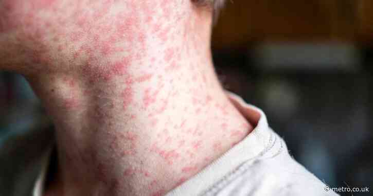 Map reveals UK measles hotspots, as Victorian disease hits 1,000 cases