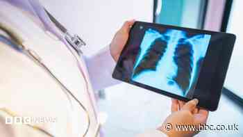 Lung cancer screening sees 10,000 people take part