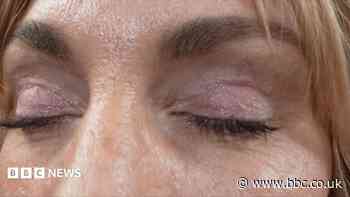 'My eyelids became infected - I was scared to sleep'