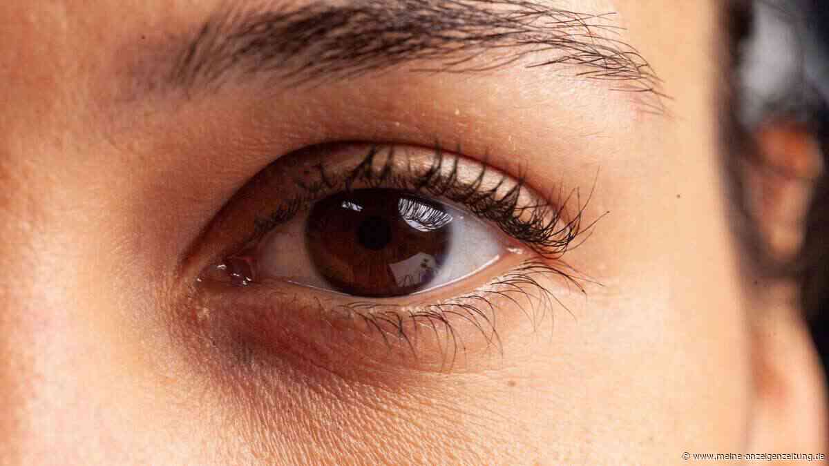 „Ferritin Face“: Kann man Eisenmangel wirklich im Gesicht erkennen?