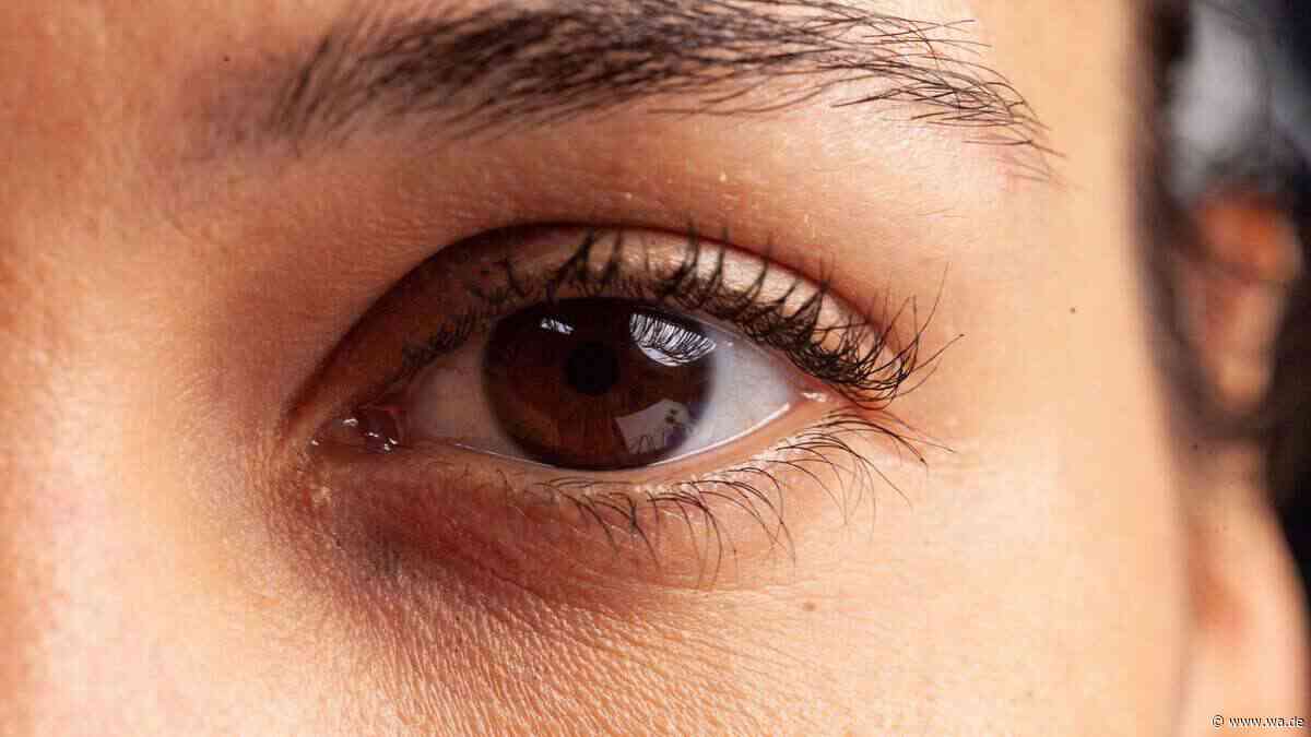 „Ferritin Face“: Kann man Eisenmangel wirklich im Gesicht erkennen?