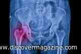 Bone Loss After Menopause Can Raise Osteoporosis Risk, the "Silent Disease"