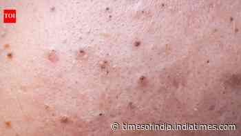 Simple Home Acne Remedies: Guide to 5 breakout types; gentle fixes and habits to avoid scars
