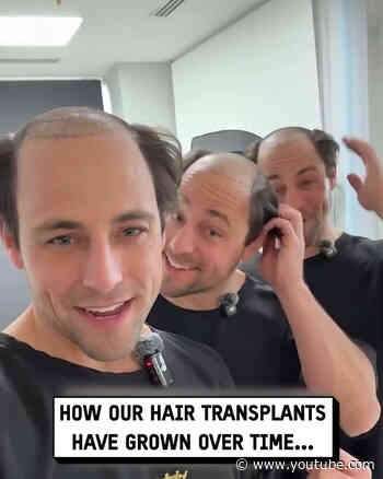 Identical triplets get hair transplants together! #hairtransplant #triplets #transformation