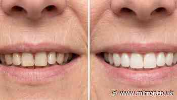 Woman's tea-stained 'yellow' teeth now 'so much whiter' with 32p-a-use buy