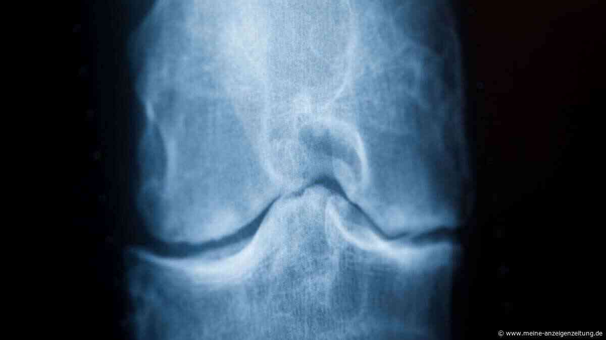Kollagen bei Arthrose? Es kann helfen, nur anders, als viele denken
