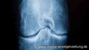 Kollagen bei Arthrose? Es kann helfen, nur anders, als viele denken