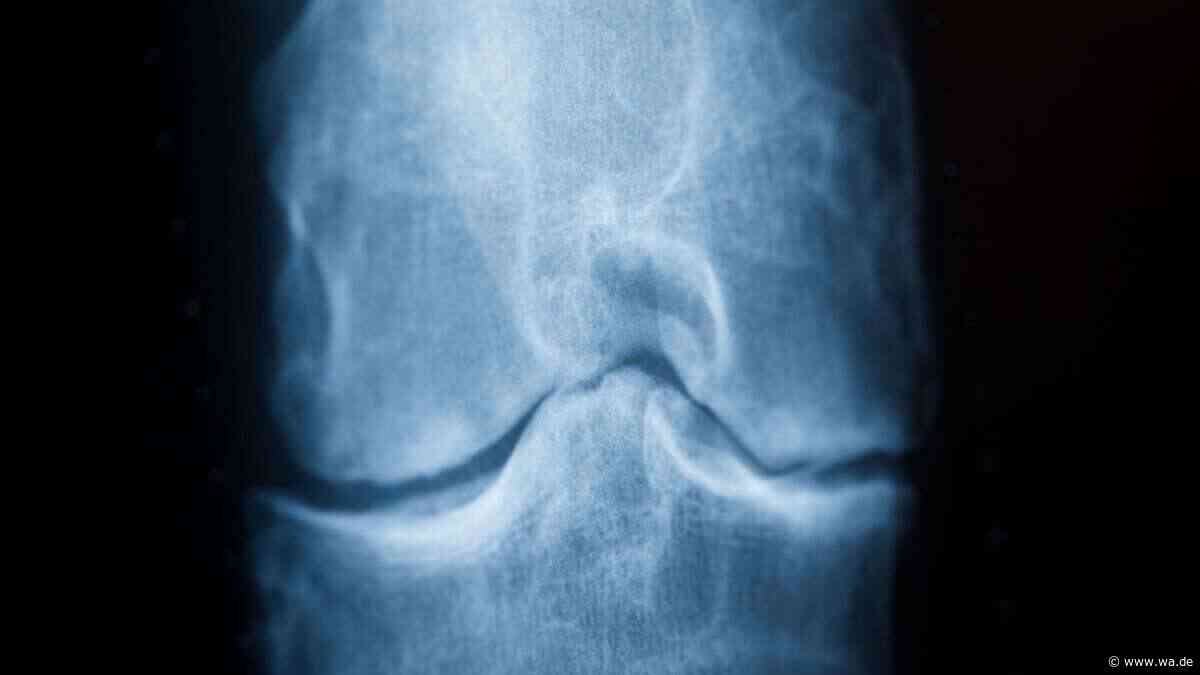 Kollagen bei Arthrose? Es kann helfen, nur anders, als viele denken