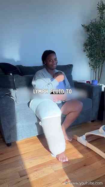 Why I have to wrap my legs every single day #lymphedema #dailyvlog