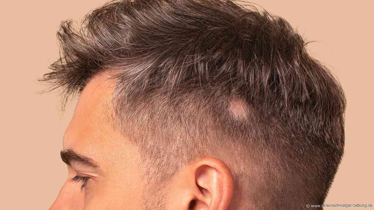 Kreisrunder Haarausfall: Medikament kann Haare vollständig zurückwachsen lassen