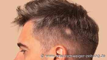Kreisrunder Haarausfall: Medikament kann Haare vollständig zurückwachsen lassen