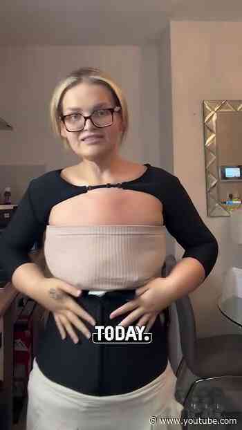 This is what happens after losing 100+ lbs #weightloss #transformation #surgery
