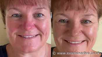 Rosacea sufferers 'feel a million dollars' with 'miracle' £24 anti-redness cream