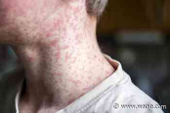 Health Department says zoo visitors possibly exposed to measles