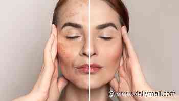 Have you noticed a change in your skin recently? Blotches that weren't there a few months ago? You could be showing signs of a 'September skin hangover'... Here's what you should do about it - and what you should definitely NOT do!