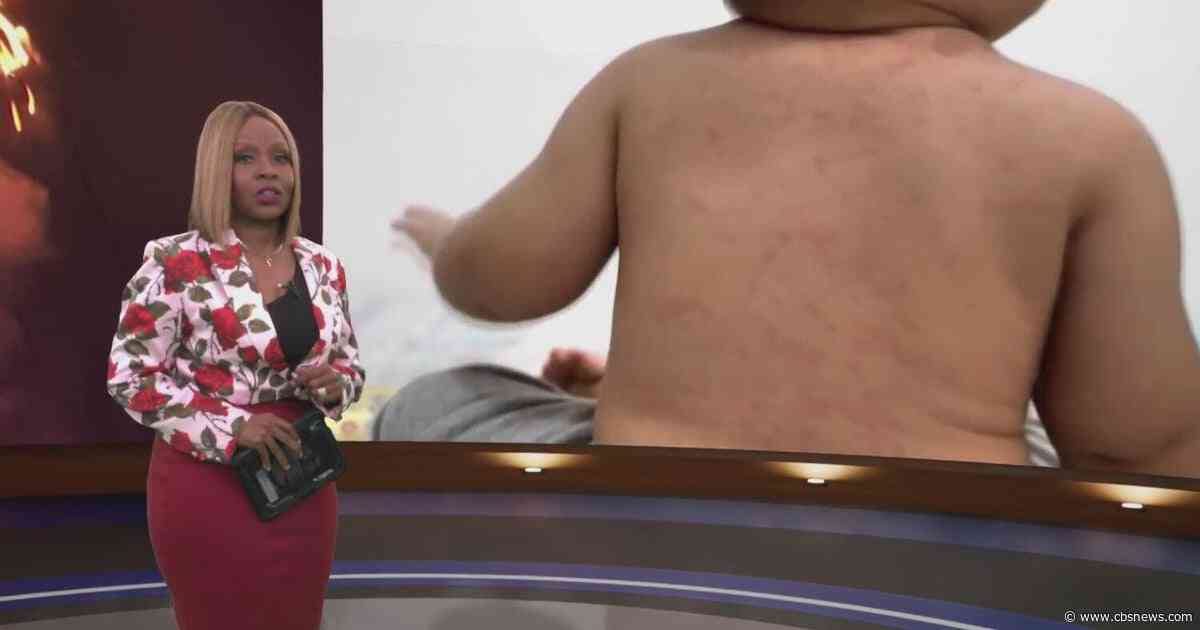 Trending Now: New Georgia measles cases, Macon shooting arrests, and more